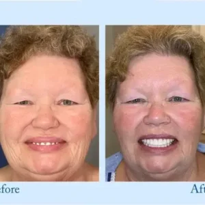 ๐๐ข๐๐จ๐ง๐ยฎ ๐๐ซ๐๐ฆ๐ข๐ฎ๐ฆ ๐๐๐ง๐ญ๐ฎ๐ซ๐