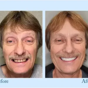 ๐๐ข๐๐จ๐ง๐ยฎ ๐๐ซ๐๐ฆ๐ข๐ฎ๐ฆ ๐๐๐ง๐ญ๐ฎ๐ซ๐