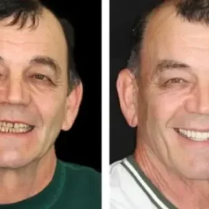 ๐๐ข๐ค๐๐ง๐๐ยฎ โ๐ฆทAdvanced Customized Full Denture Set๐ฆท๐บ๐ธ (โฐLimited time discount last 30 minutesโฐ)