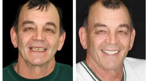 ๐๐ข๐ค๐๐ง๐๐ยฎ โ๐ฆทAdvanced Customized Full Denture Set๐ฆท๐บ๐ธ (โฐLimited time discount last 30 minutesโฐ)