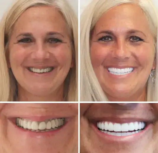 ๐๐ข๐ค๐๐ง๐๐ยฎ โ๐ฆทAdvanced Customized Full Denture Set๐ฆท๐บ๐ธ (โฐLimited time discount last 30 minutesโฐ)