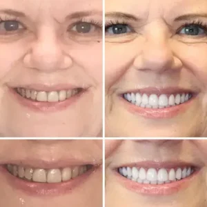 ๐๐ข๐ค๐๐ง๐๐ยฎ โ๐ฆทAdvanced Customized Full Denture Set๐ฆท๐บ๐ธ (โฐLimited time discount last 30 minutesโฐ)