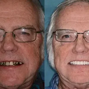 ๐๐ข๐ค๐๐ง๐๐ยฎ โ๐ฆทAdvanced Customized Full Denture Set๐ฆท๐บ๐ธ (โฐLimited time discount last 30 minutesโฐ)