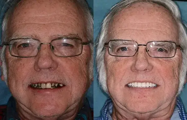 ๐๐ข๐ค๐๐ง๐๐ยฎ โ๐ฆทAdvanced Customized Full Denture Set๐ฆท๐บ๐ธ (โฐLimited time discount last 30 minutesโฐ)