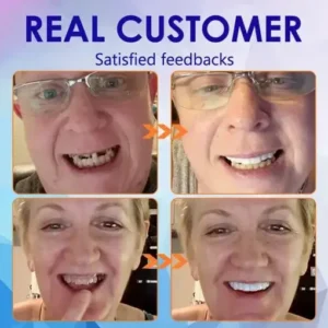 NESLEMY™- Advanced Customized Full Denture Set