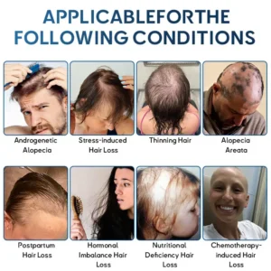 🇺🇸🌱Developed by Trichologists: 𝐑𝐨𝐥𝐢𝐦𝐞𝐲® 𝐒𝐓𝐄𝐌 𝐂𝐞𝐥𝐥 𝐇𝐚𝐢𝐫 𝐂𝐲𝐜𝐥𝐞 𝐑𝐨𝐥𝐥𝐞𝐫 – Instantly Stops Hair Loss & Promotes Real Regrowth (🔥UP TO 80% OFF🔥)