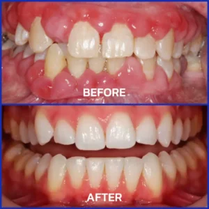 Rolimey® VioGloss Bienengift-Zahntherapie Oral Power
