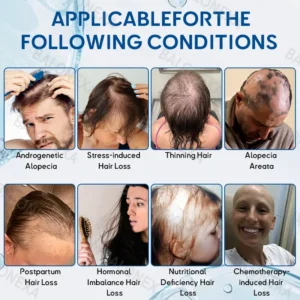 ✅US Owned and Operated: 𝙍𝙤𝙡𝙞𝙢𝙚𝙮® 𝙎𝙏𝙀𝙈 𝘾𝙚𝙡𝙡 𝙃𝙖𝙞𝙧 𝘾𝙮𝙘𝙡𝙚 𝙍𝙤𝙡𝙡𝙚𝙧 (Male pattern baldness · Thinning hair · Receding hairline · Postpartum hair loss · Stress-related shedding · Ageing hair · Scalp discomfort)