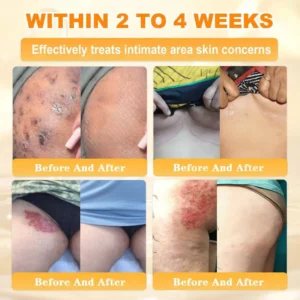 🐝🌿FDA Approved|Rolimey® Bee Venom Skin Restoration Cream(Anti-aging, Hydrating, Skin Repair, Even Tone, Acne and Dark Spot Treatment, Wart and Mole Removal, Psoriasis Relief)