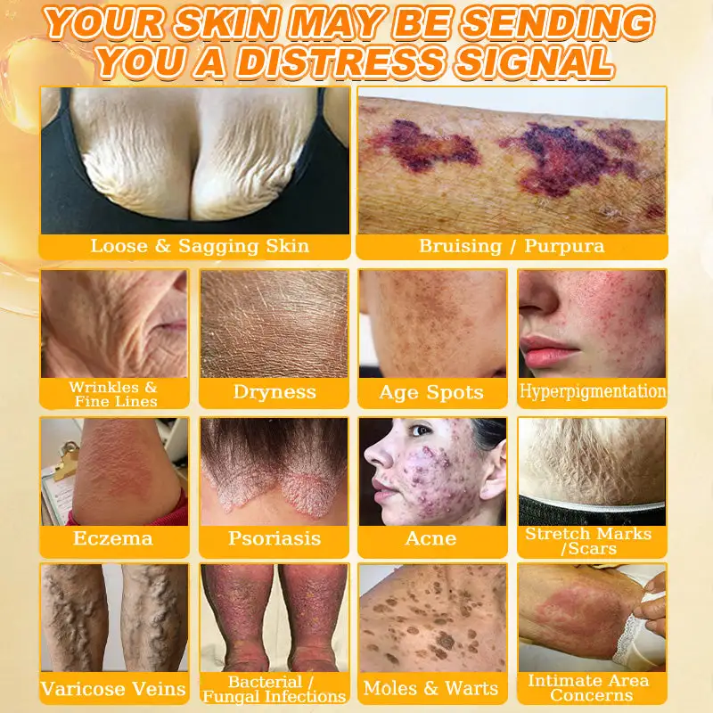 🐝🌿FDA Approved|Rolimey® Bee Venom Skin Restoration Cream(Anti-aging, Hydrating, Skin Repair, Even Tone, Acne and Dark Spot Treatment, Wart and Mole Removal, Psoriasis Relief)