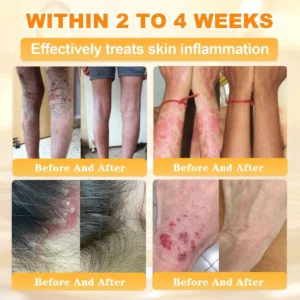 🐝🌿FDA Approved|Rolimey® Bee Venom Skin Restoration Cream(Anti-aging, Hydrating, Skin Repair, Even Tone, Acne and Dark Spot Treatment, Wart and Mole Removal, Psoriasis Relief)