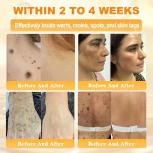 🐝🌿FDA Approved|Rolimey® Bee Venom Skin Restoration Cream(Anti-aging, Hydrating, Skin Repair, Even Tone, Acne and Dark Spot Treatment, Wart and Mole Removal, Psoriasis Relief)