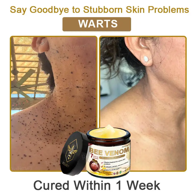 ✨Made and Shipped from UK✨Rolimey® Bee Venom Skin Comprehensive Cream Anti-aging, Hydrating, Skin Repair, Even Tone, Acne and Dark Spot Treatment, Wart and Mole Removal, Psoriasis Relief
