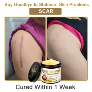 ✨Made and Shipped from UK✨Rolimey® Bee Venom Skin Comprehensive Cream Anti-aging, Hydrating, Skin Repair, Even Tone, Acne and Dark Spot Treatment, Wart and Mole Removal, Psoriasis Relief