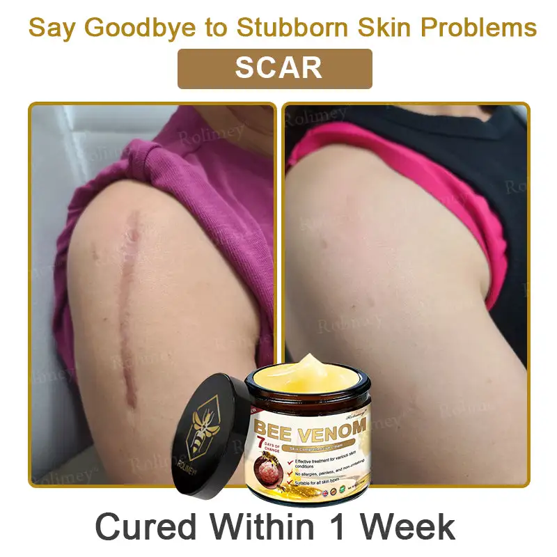 ✨Made and Shipped from UK✨Rolimey® Bee Venom Skin Comprehensive Cream Anti-aging, Hydrating, Skin Repair, Even Tone, Acne and Dark Spot Treatment, Wart and Mole Removal, Psoriasis Relief