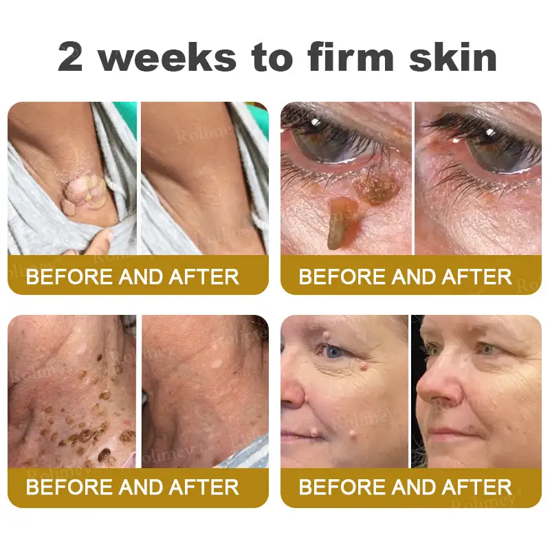 ✨Made and Shipped from UK✨Rolimey® Bee Venom Skin Comprehensive Cream Anti-aging, Hydrating, Skin Repair, Even Tone, Acne and Dark Spot Treatment, Wart and Mole Removal, Psoriasis Relief