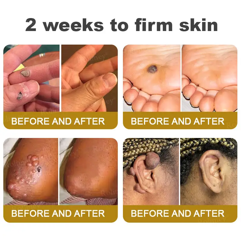 ✨Made and Shipped from UK✨Rolimey® Bee Venom Skin Comprehensive Cream Anti-aging, Hydrating, Skin Repair, Even Tone, Acne and Dark Spot Treatment, Wart and Mole Removal, Psoriasis Relief