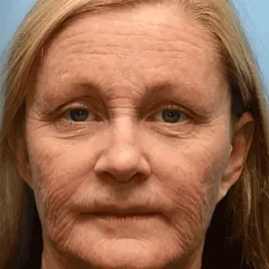 ✨Made and Shipped from UK✨Rolimey® Bee Venom Skin Comprehensive Cream Anti-aging, Hydrating, Skin Repair, Even Tone, Acne and Dark Spot Treatment, Wart and Mole Removal, Psoriasis Relief