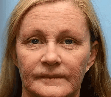 ✨Made and Shipped from UK✨Rolimey® Bee Venom Skin Comprehensive Cream Anti-aging, Hydrating, Skin Repair, Even Tone, Acne and Dark Spot Treatment, Wart and Mole Removal, Psoriasis Relief