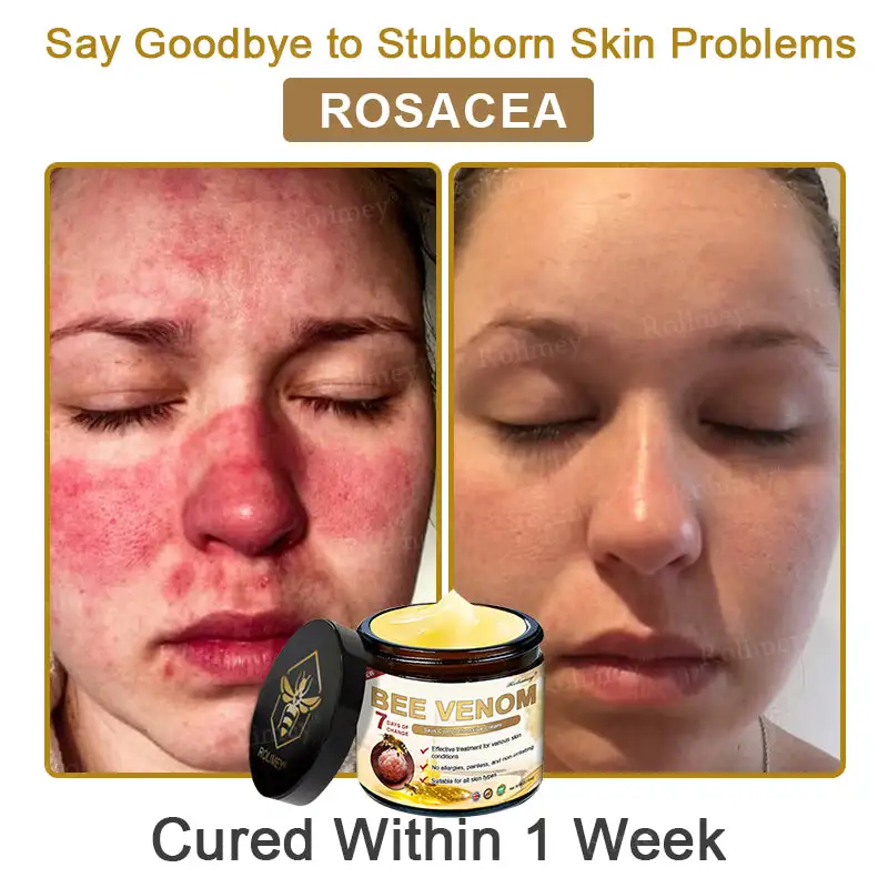 ✨Made and Shipped from UK✨Rolimey® Bee Venom Skin Comprehensive Cream Anti-aging, Hydrating, Skin Repair, Even Tone, Acne and Dark Spot Treatment, Wart and Mole Removal, Psoriasis Relief