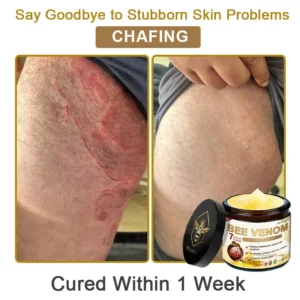 ✨Made and Shipped from UK✨Rolimey® Bee Venom Skin Comprehensive Cream Anti-aging, Hydrating, Skin Repair, Even Tone, Acne and Dark Spot Treatment, Wart and Mole Removal, Psoriasis Relief