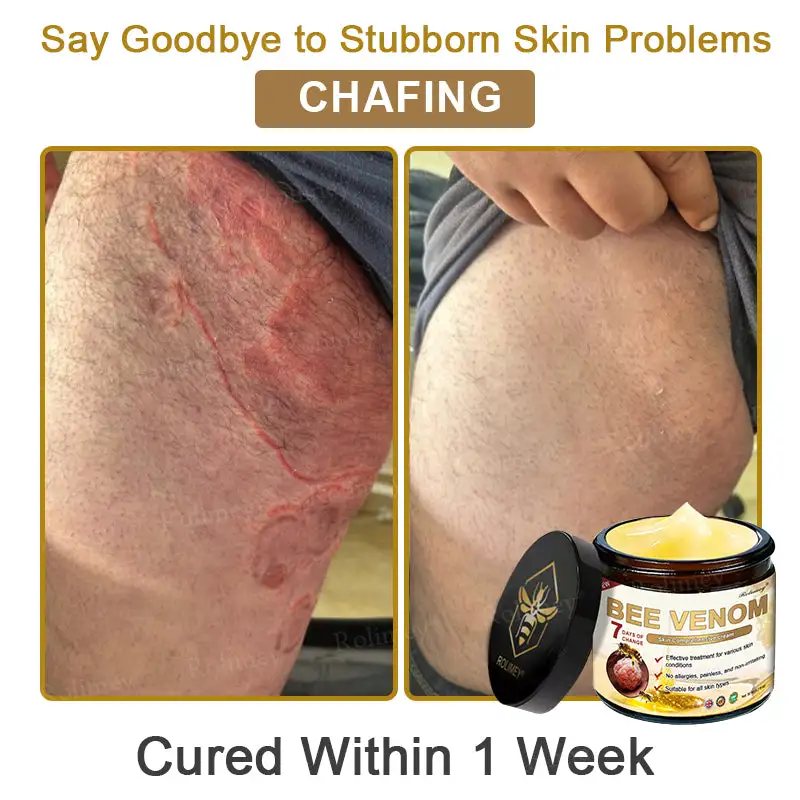 ✨Made and Shipped from UK✨Rolimey® Bee Venom Skin Comprehensive Cream Anti-aging, Hydrating, Skin Repair, Even Tone, Acne and Dark Spot Treatment, Wart and Mole Removal, Psoriasis Relief