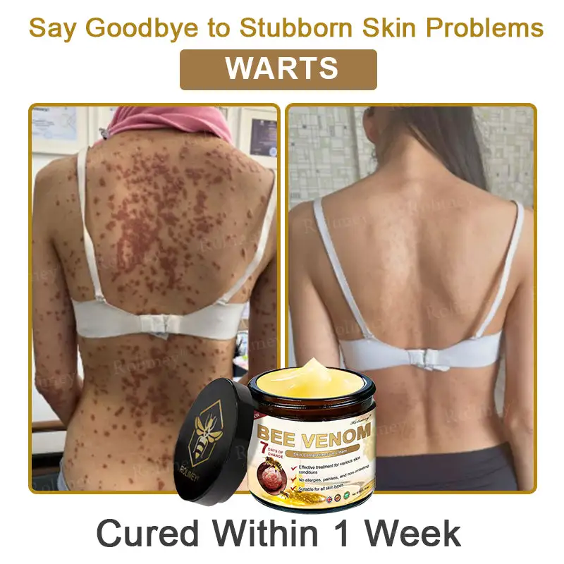 ✨Made and Shipped from UK✨Rolimey® Bee Venom Skin Comprehensive Cream Anti-aging, Hydrating, Skin Repair, Even Tone, Acne and Dark Spot Treatment, Wart and Mole Removal, Psoriasis Relief