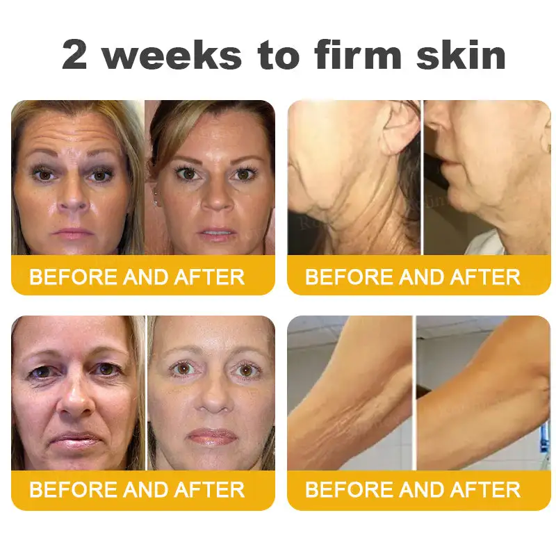 (🌟Made and Shipped from UK)✨Rolimey® Botox Bee Venom Wrinkle Removal Cream👩🔬Dermatologist-Tested🔥LAST DAY 70% OFF