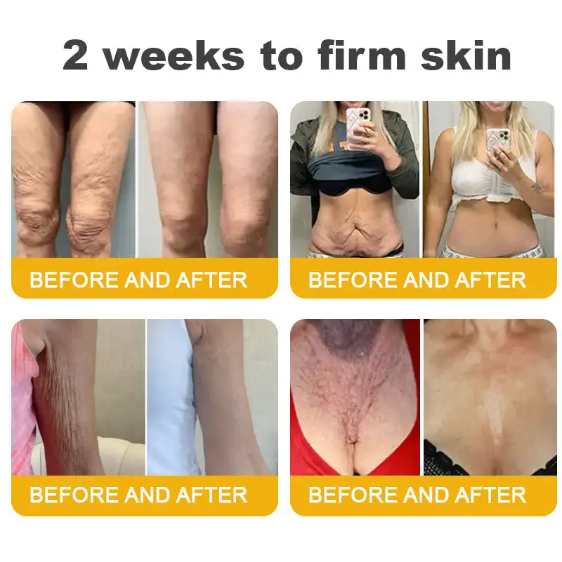 (🌟Made and Shipped from UK)✨Rolimey® Botox Bee Venom Wrinkle Removal Cream👩🔬Dermatologist-Tested🔥LAST DAY 70% OFF