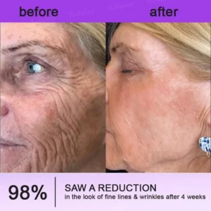 👁️💫Rolimey® NAD+ Retinol Firming & Lifting Cream – For Eye Bags, Dark Circles & Fine Lines | Last Day Sale: 60% OFF