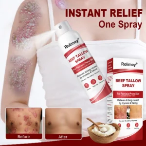 Rolimey® Beef Tallow Spray for Itchy, Flaky Psoriasis Skin