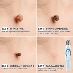 🩵Official Brand Shop | Rolimey® 7-Day Roll-On for Skin Spots and Skin Tags – Pain-Free & Scar-Free