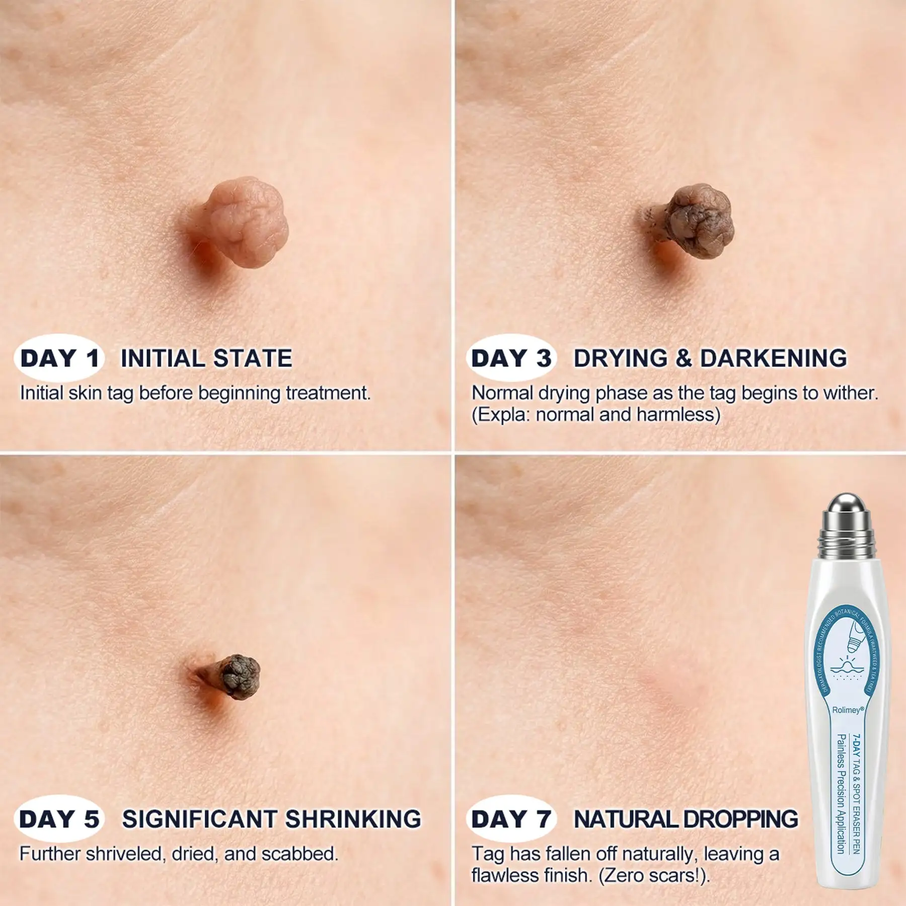 🩵Official Brand Shop | Rolimey® 7-Day Roll-On for Skin Spots and Skin Tags – Pain-Free & Scar-Free